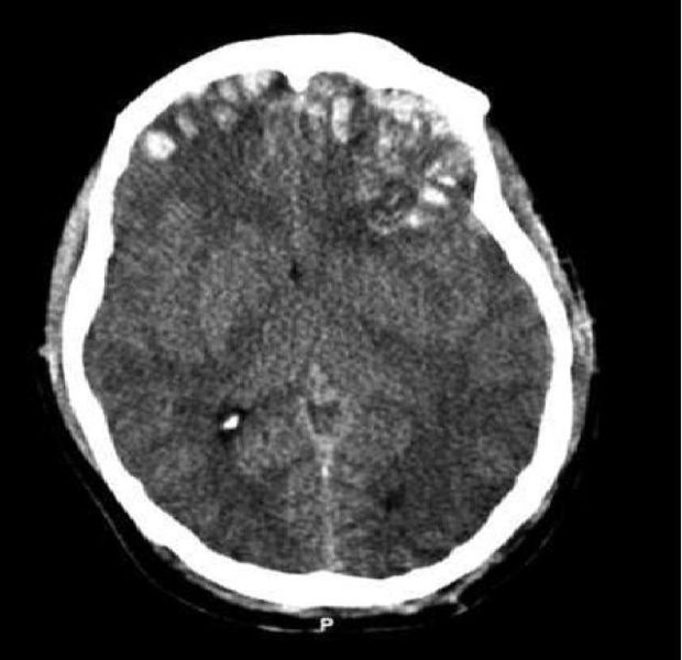 Brain_trauma_CT_341846435.jpg